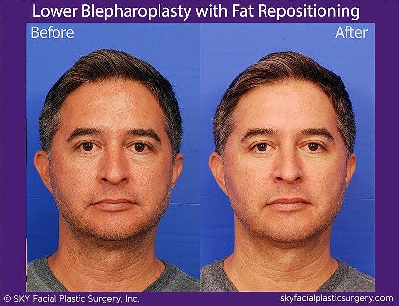 Blepharoplasty Before & After