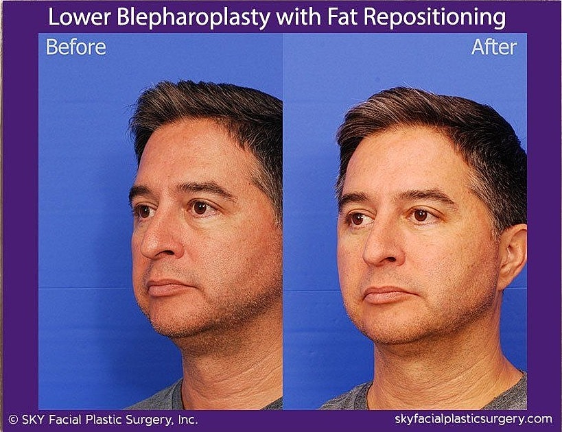 Blepharoplasty Before & After