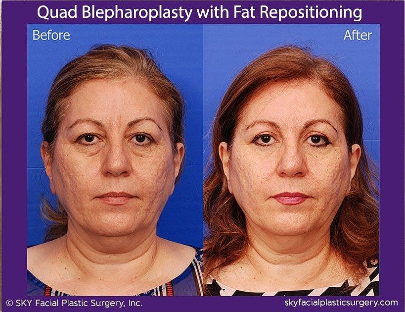 Blepharoplasty Before & After