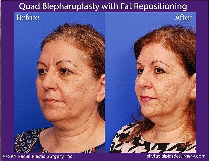 Blepharoplasty Before & After