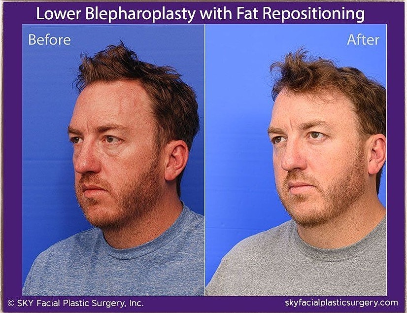Blepharoplasty Before & After