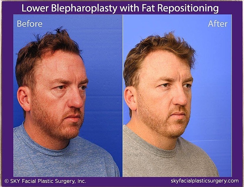 Blepharoplasty Before & After