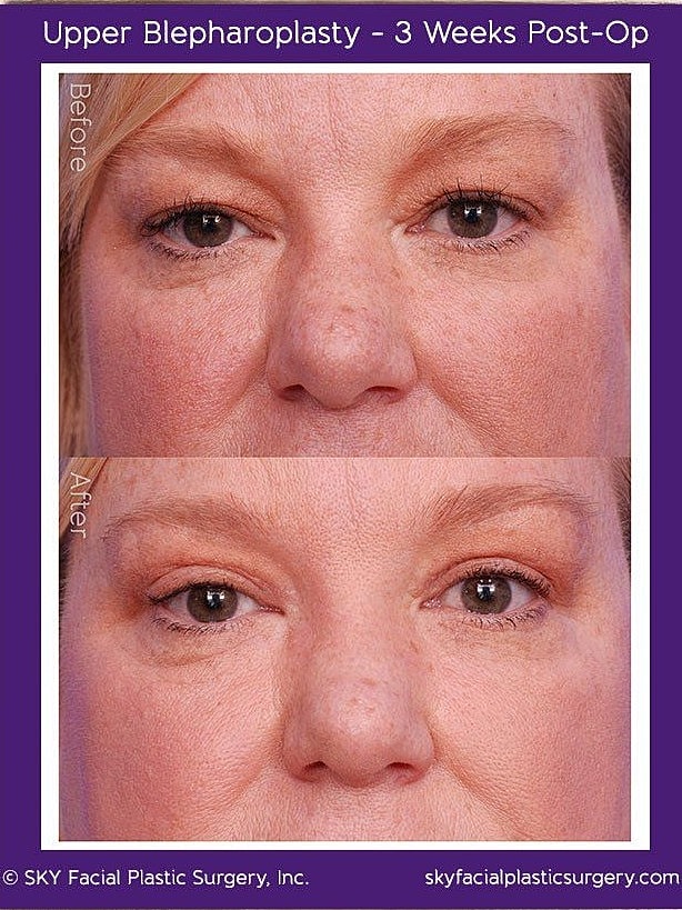 Blepharoplasty Before & After