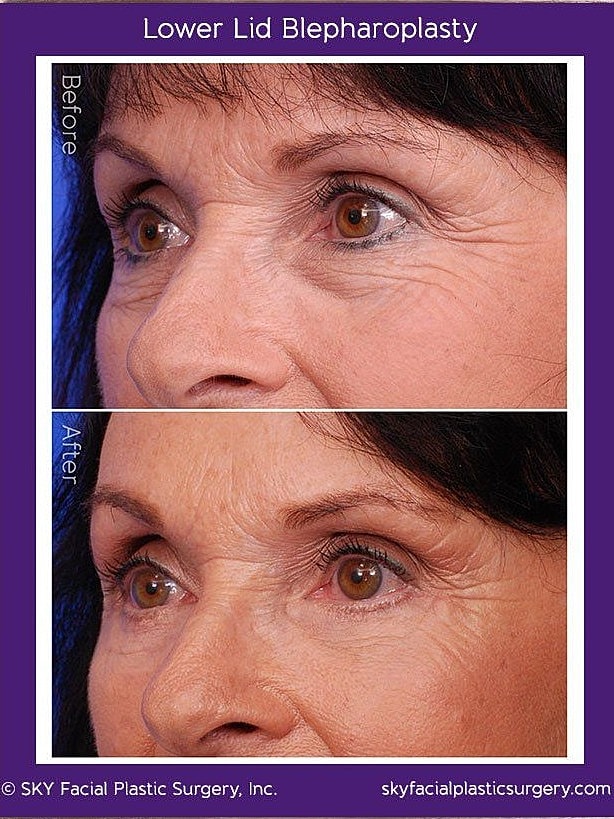 Blepharoplasty Before & After