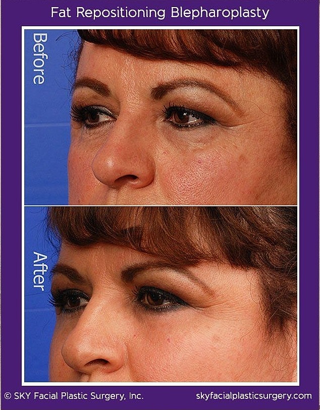 Blepharoplasty Before & After