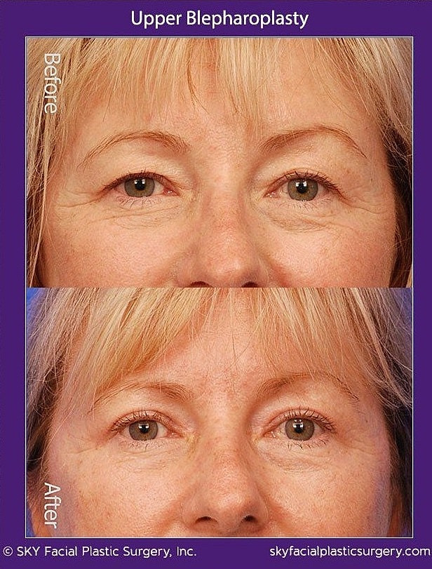 Blepharoplasty Before & After
