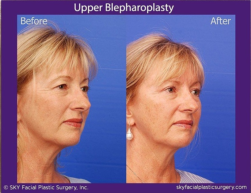 Blepharoplasty Before & After
