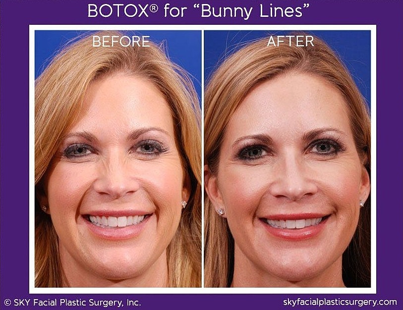 Botox To Bunny Lines Before & After
