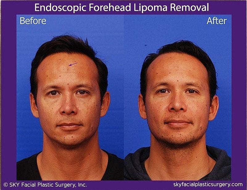 Endoscopic Forehead Lipoma Removal Before & After