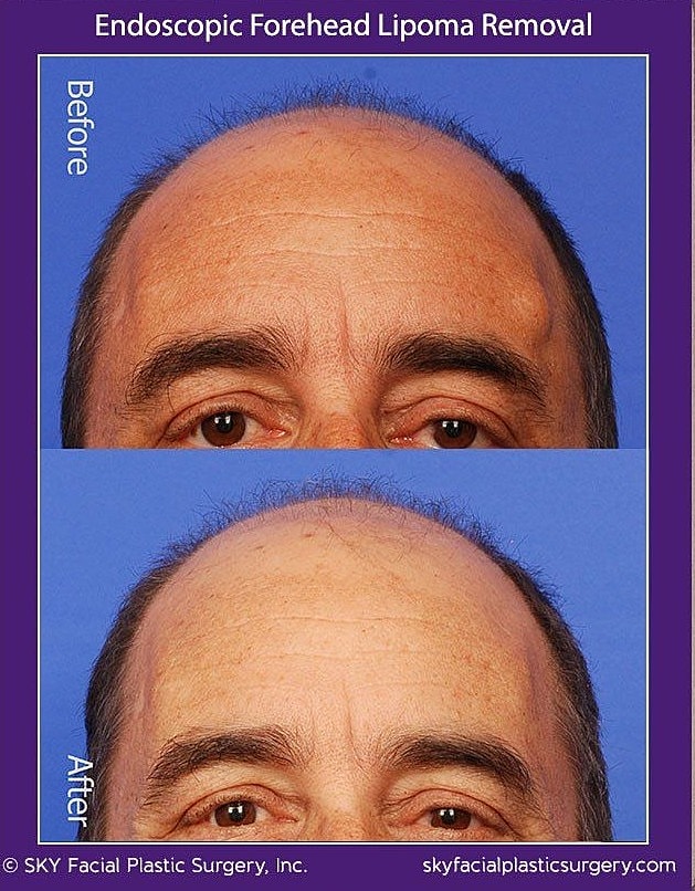 Endoscopic Forehead Lipoma Removal Before & After