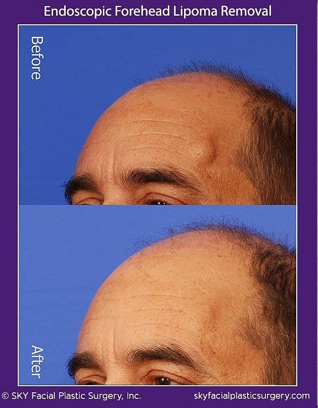Endoscopic Forehead Lipoma Removal Before & After