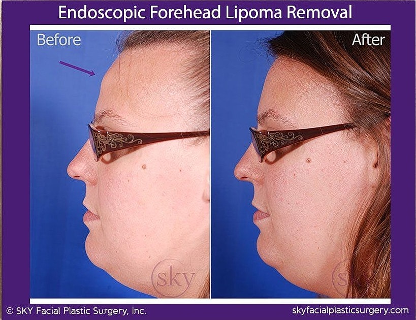 Endoscopic Forehead Lipoma Removal Before & After