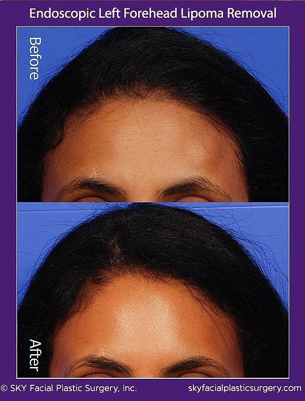 Endoscopic Forehead Lipoma Removal Before & After