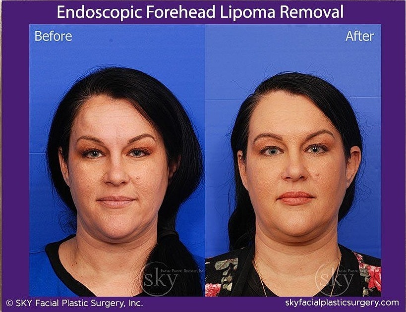 Endoscopic Forehead Lipoma Removal Before & After