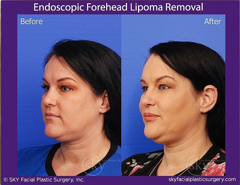 Endoscopic Forehead Lipoma Removal Before & After