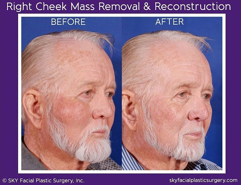 Reconstructive Surgery Before & After