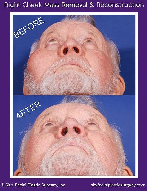 Reconstructive Surgery Before & After