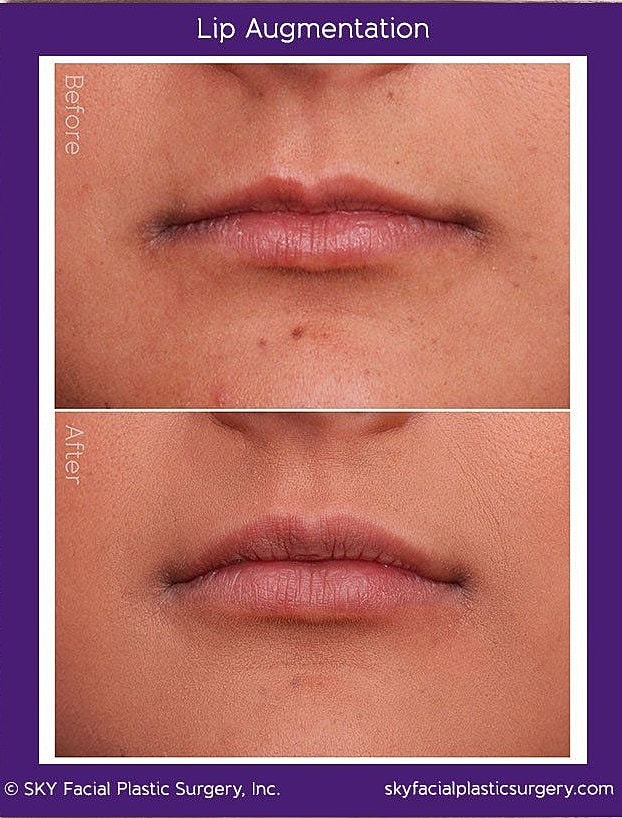 Lip Filler Before & After