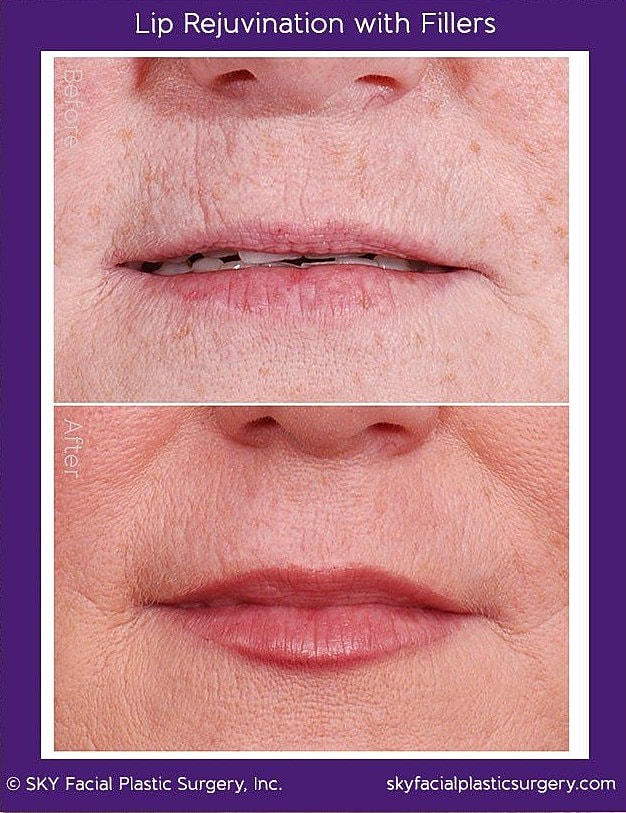 Lip Filler Before & After