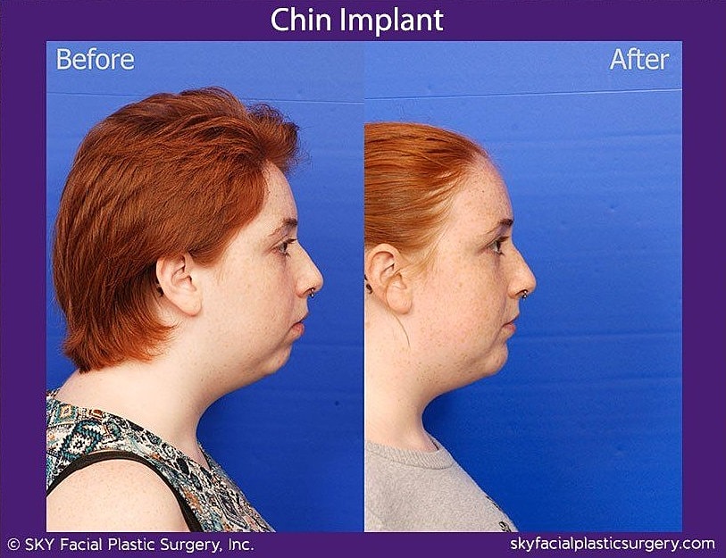 Chin Implant Before & After