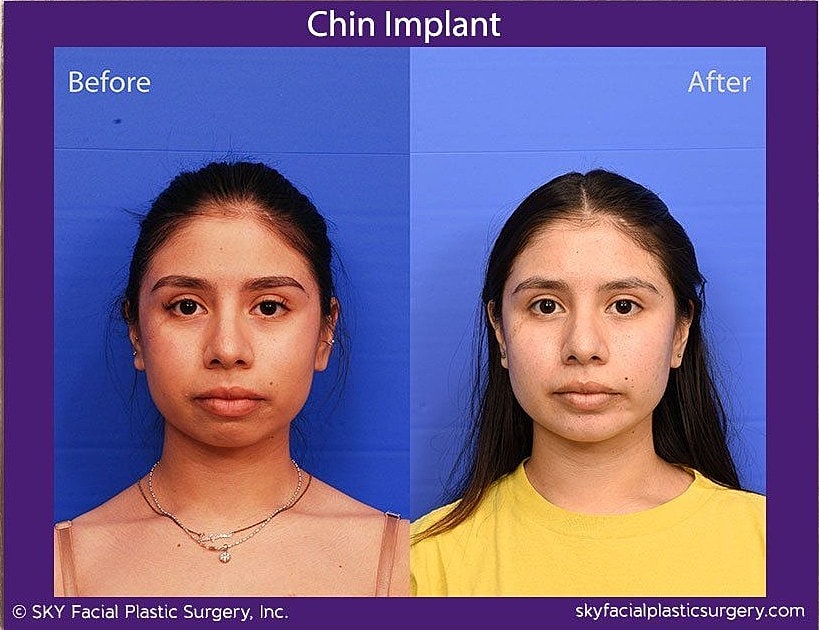 Chin Implant Before & After