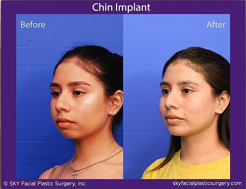 Chin Implant Before & After