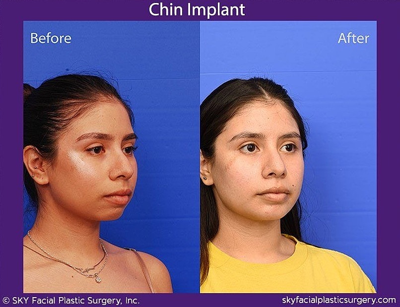 Chin Implant Before & After