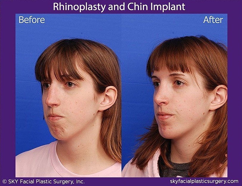 Chin Implant Before & After