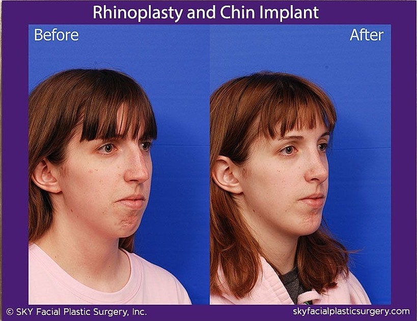 Chin Implant Before & After