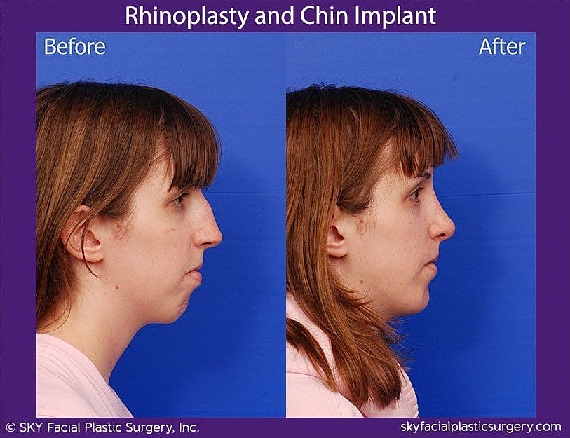 Chin Implant Before & After