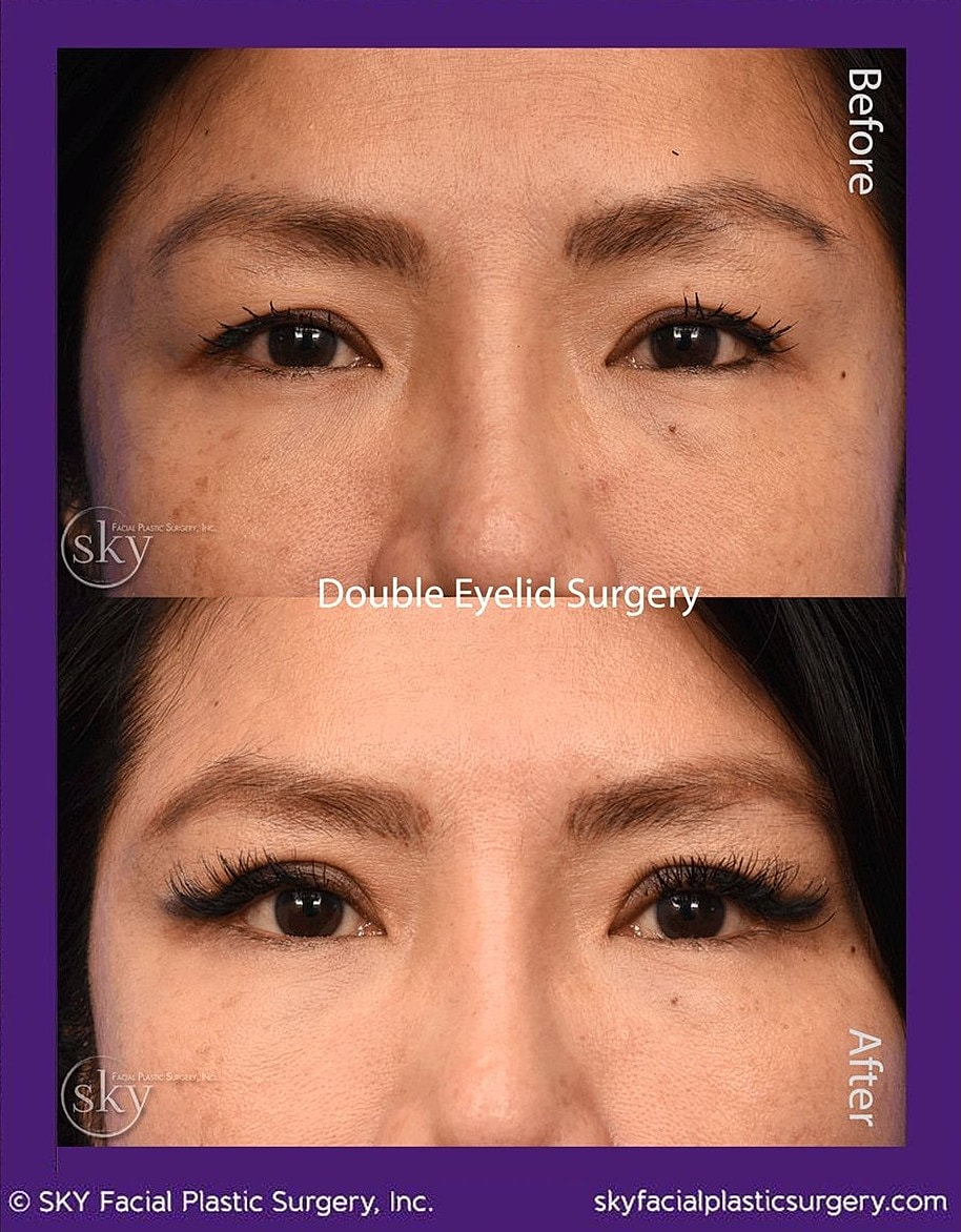 Asian Blepharoplasty Before & After