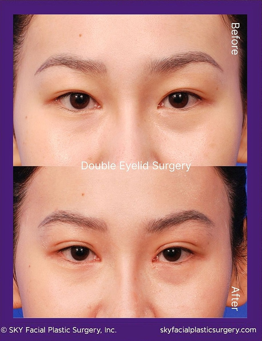 Asian Blepharoplasty Before & After