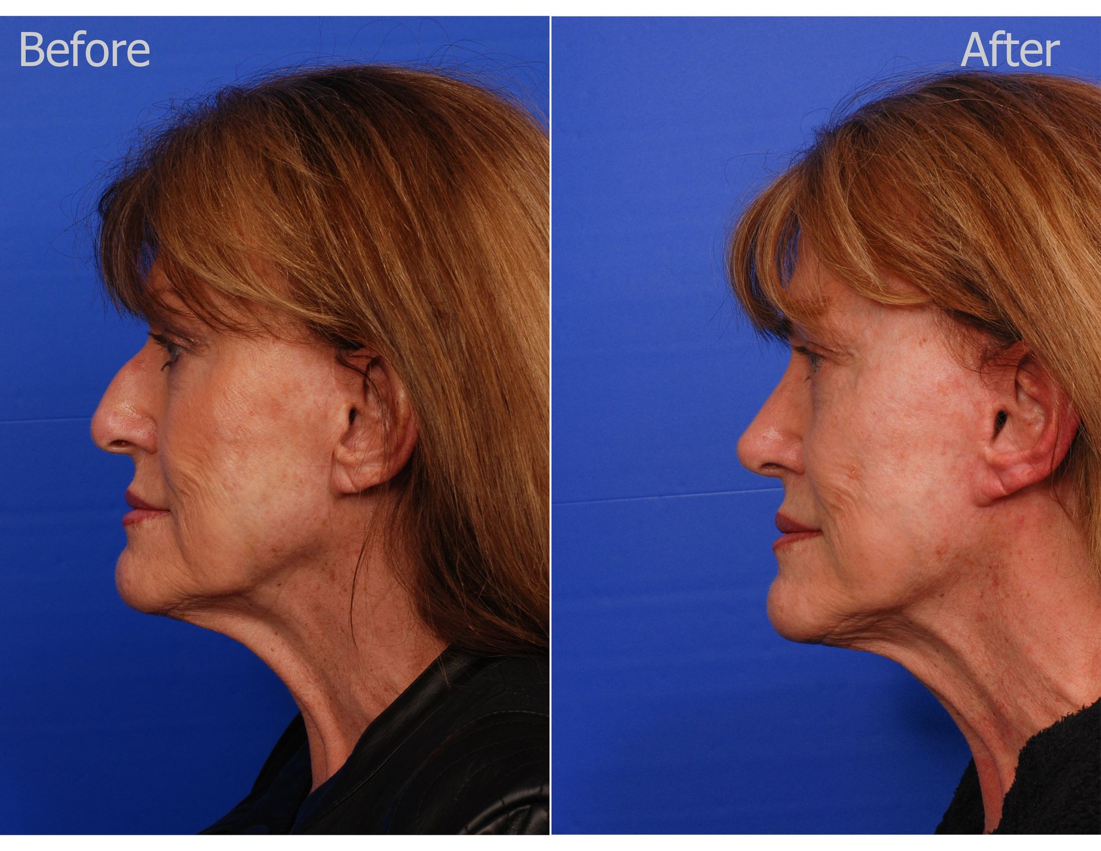 Diary of a Rhinoplasty Patient: New Nose Review