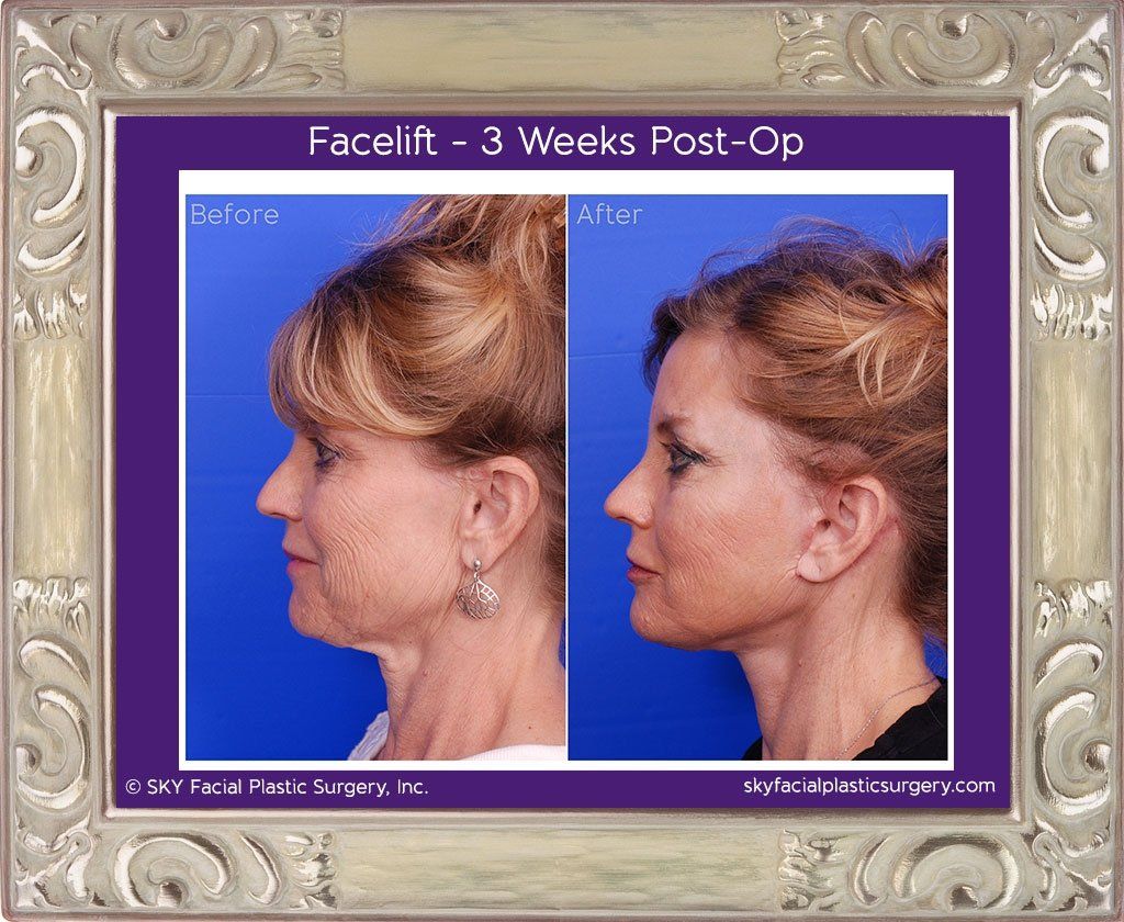 Mini-facelift, Mini Results?