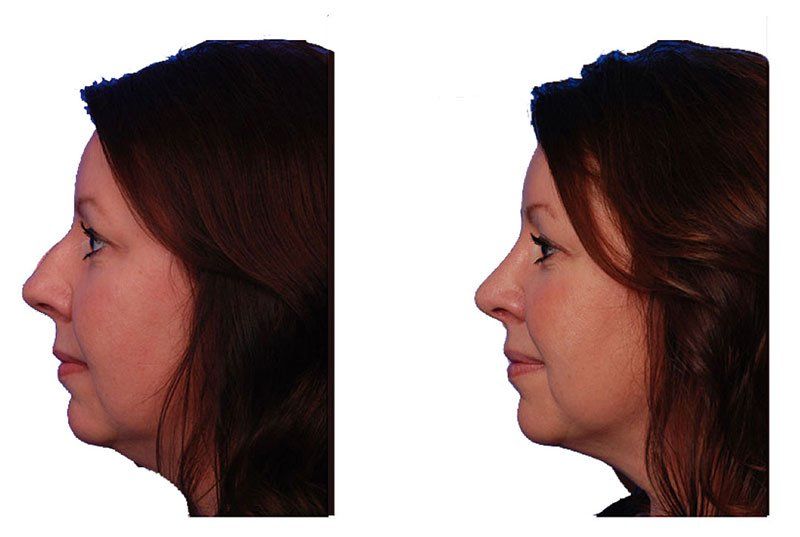 How to Remove a Dorsal Hump (Nose Bump)
