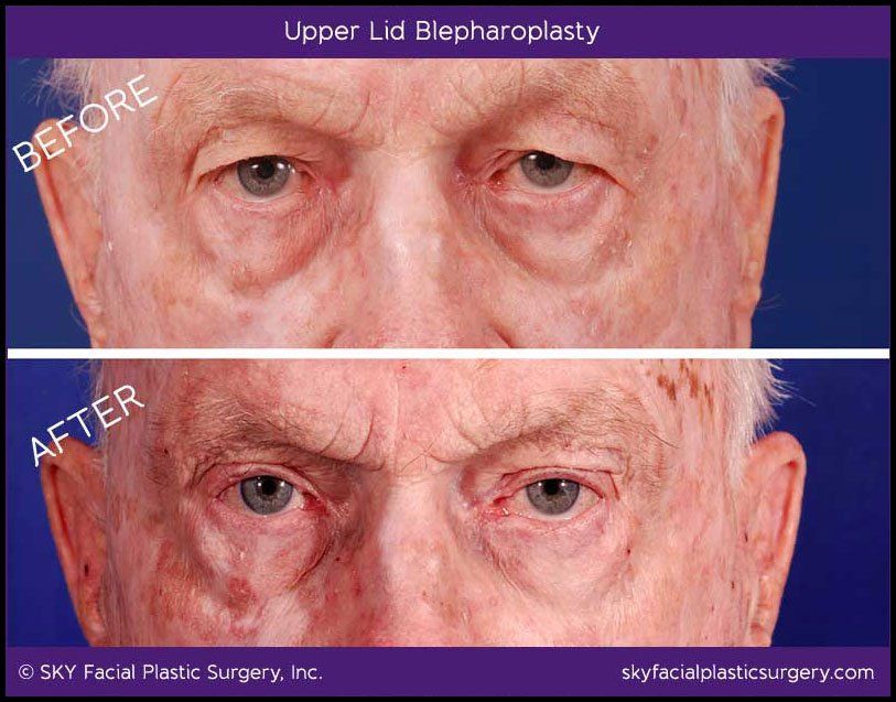 Identification of a Common Cause of Visual Impairment
