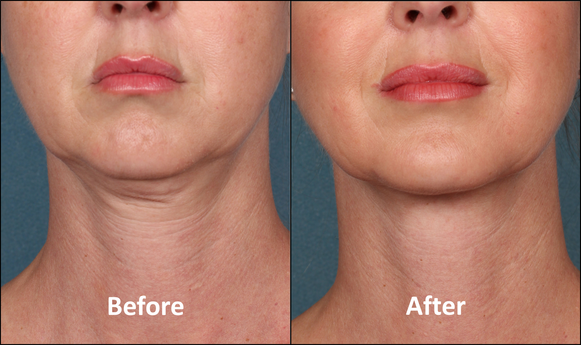 Say Goodbye to Your Double Chin!